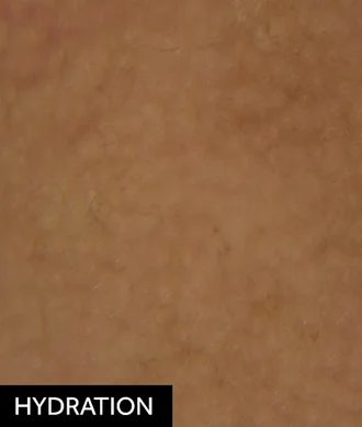 Hydration